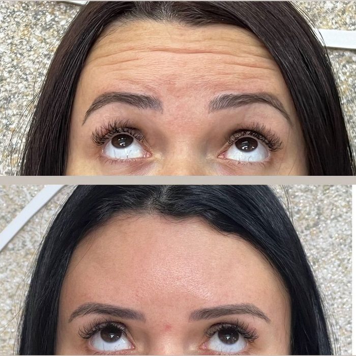Fotografia em duas metades da mesma paciente: acima a testa antes do botox full face, abaixo a mesma testa depois.