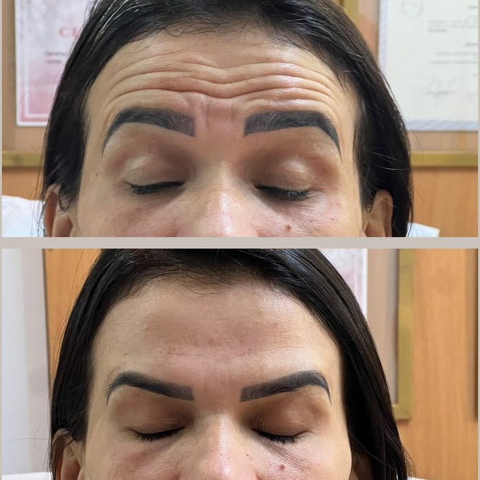Fotografia em duas metades de outra paciente: acima a testa antes do botox full face, abaixo a mesma testa depois.