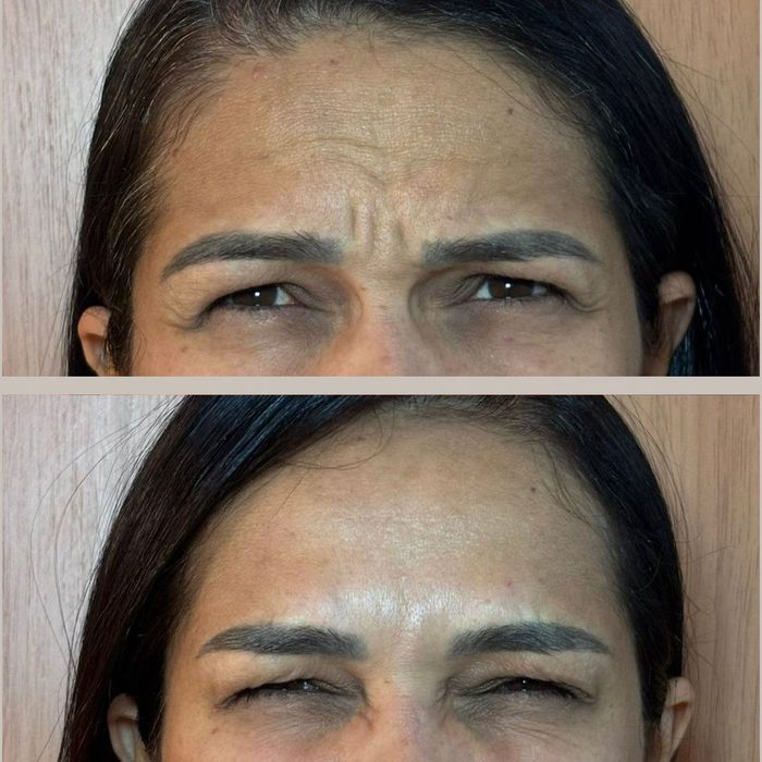 Fotografia em duas metades da mesma paciente franzindo: acima a região entre as sobrancelhas antes do botox full face, abaixo depois.