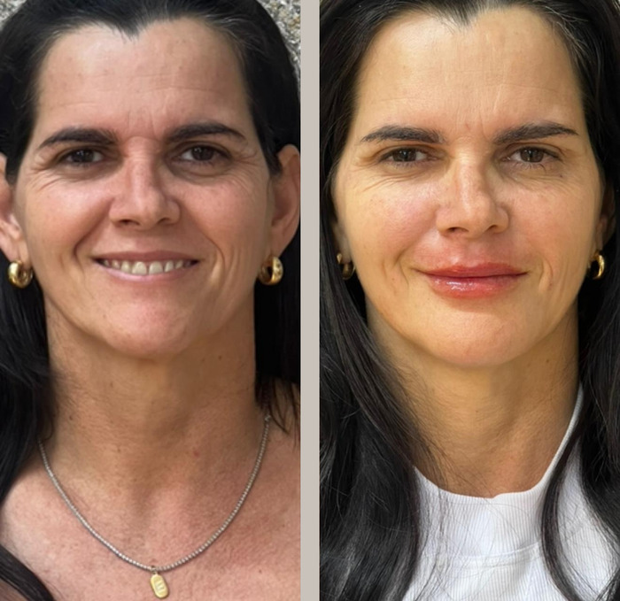 Fotografia com duas metades lado a lado, a mesma paciente: à esquerda o rosto antes da harmonização facial, à direita depois.