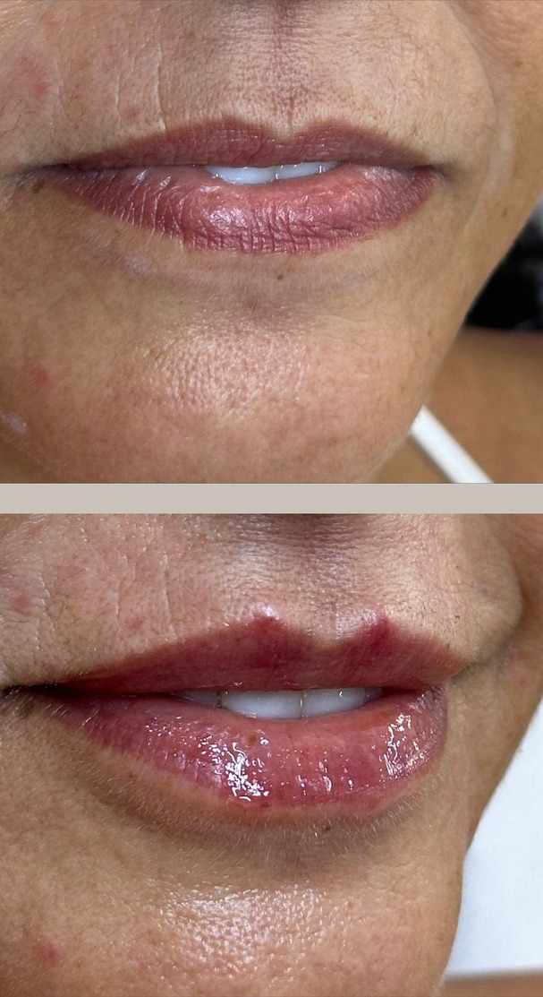 Fotografia em duas metades da mesma paciente: acima os lábios antes do preenchimento labial, abaixo os mesmos lábios depois.