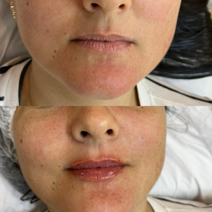Antes e depois de preenchimento labial, vista frontal