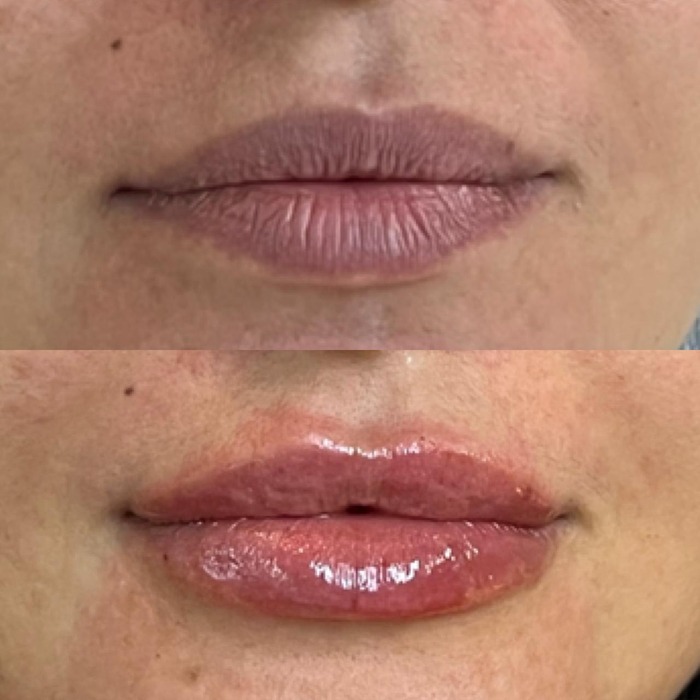 Antes e depois de preenchimento labial, close nos lábios