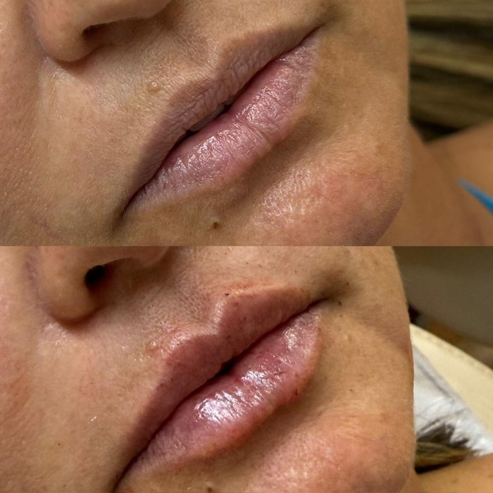 Antes e depois de preenchimento labial visto de perfil, mostrando a projeção