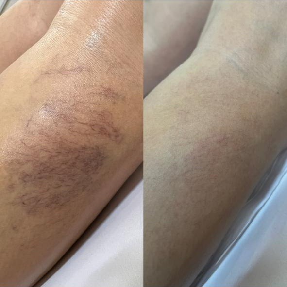 Antes e depois de microvasos no joelho
