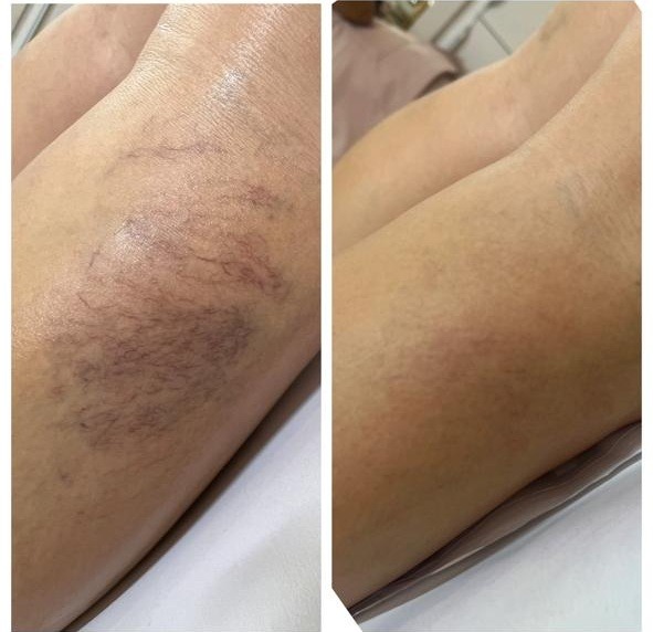 Antes e depois de microvasos no joelho de outra paciente