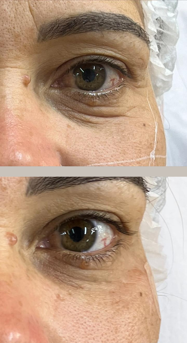 Fotografia em duas metades da mesma paciente, close de um olho: acima a olheira antes do preenchimento facial, abaixo depois.