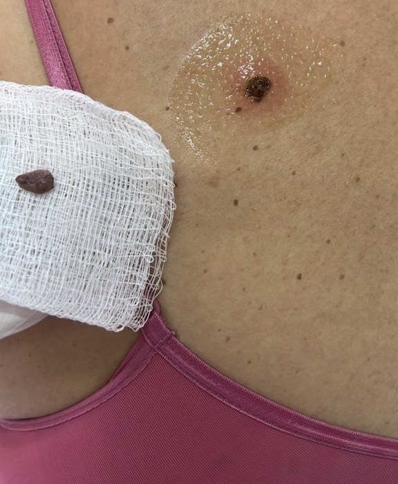 Fotografia das costas de uma paciente no dia do procedimento: o sinal removido sobre uma gaze, ao lado da região tratada.